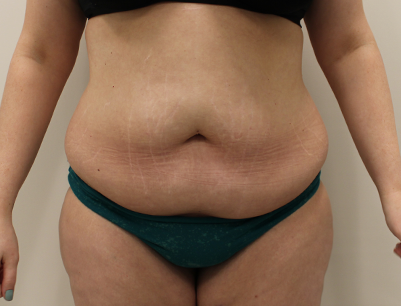 Tummy Tuck before and after - before