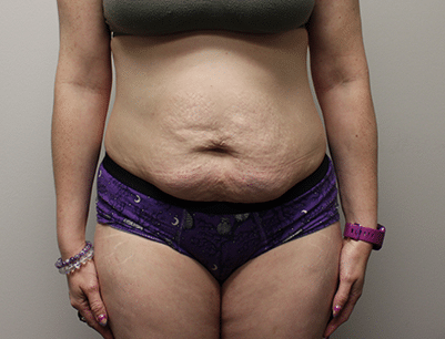 Tummy Tuck before and after - before