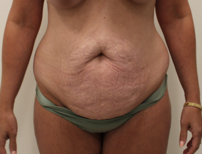 Tummy Tuck before and after - before