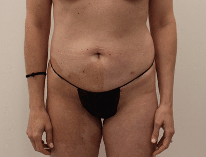Tummy Tuck before and after - before