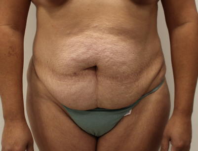 Tummy Tuck before and after - before