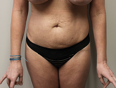 Tummy Tuck before and after - before