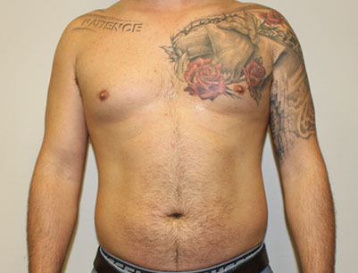 Liposuction before and after - before