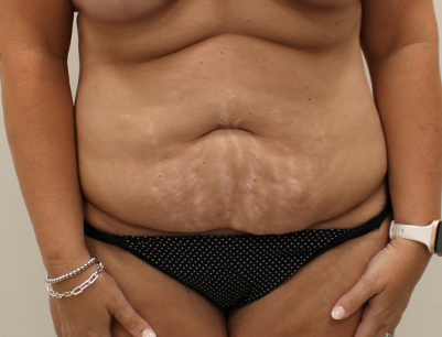 Tummy Tuck before and after - before