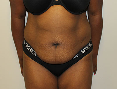 Tummy Tuck before and after - before