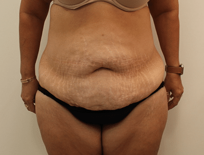 Tummy Tuck before and after - before