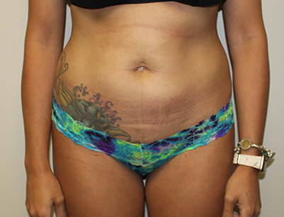 Liposuction before and after - before