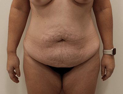 Tummy Tuck before and after - before