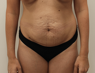 Tummy Tuck before and after - before