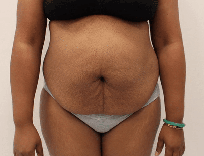 Tummy Tuck before and after - before