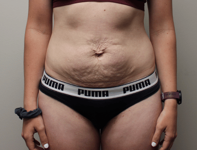 Tummy Tuck before and after - before