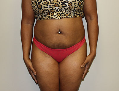 Tummy Tuck before and after - before