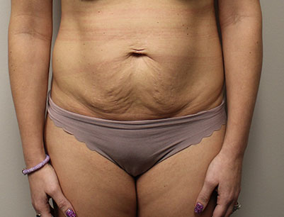 Tummy Tuck before and after - before