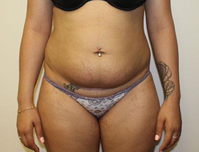 Liposuction before and after - before