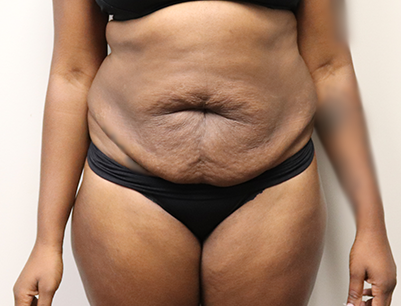 Tummy Tuck before and after - before