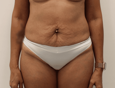 Tummy Tuck before and after - before