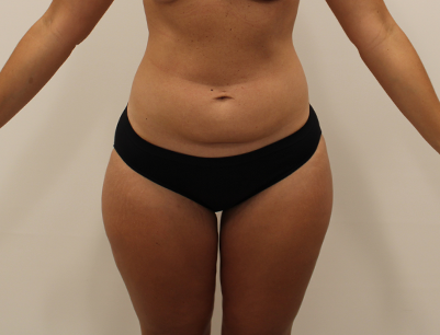 Liposuction before and after - before