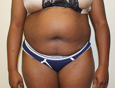Tummy Tuck before and after - before