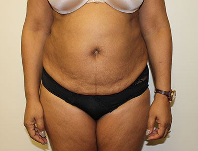 Tummy Tuck before and after - before