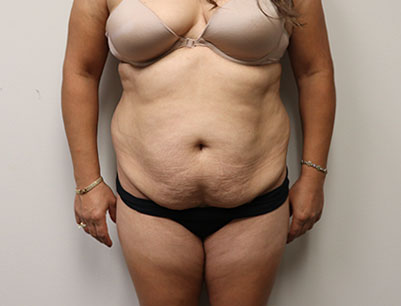 Tummy Tuck before and after - before