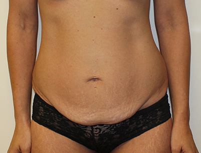 Tummy Tuck before and after - before