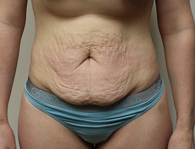 Tummy Tuck before and after - before