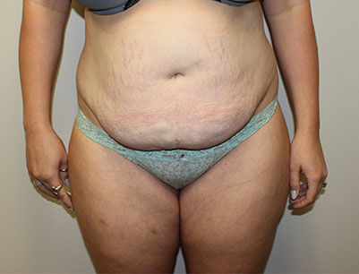 Tummy Tuck before and after - before