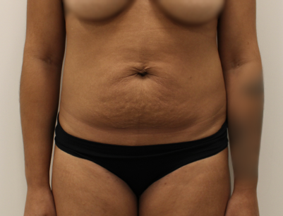 Tummy Tuck before and after - before