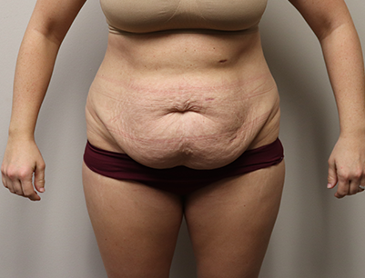 Tummy Tuck before and after - before