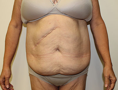 Tummy Tuck before and after - before