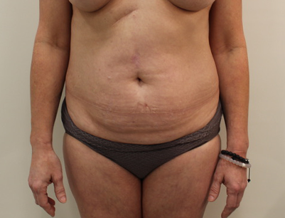 Tummy Tuck before and after - before