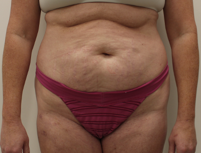 Tummy Tuck before and after - before