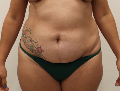 Tummy Tuck before and after - before