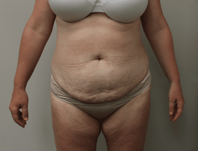 Tummy Tuck before and after - before