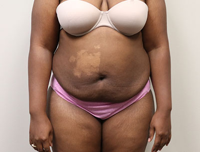 Tummy Tuck before and after - before