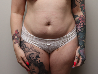 Liposuction before and after - before