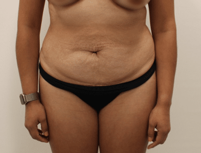 Tummy Tuck before and after - before