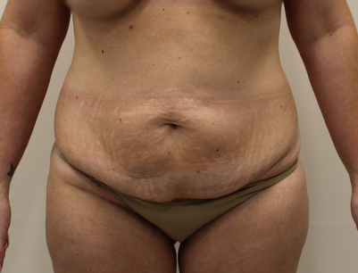 Tummy Tuck before and after - before