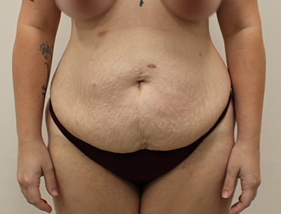 Tummy Tuck before and after - before
