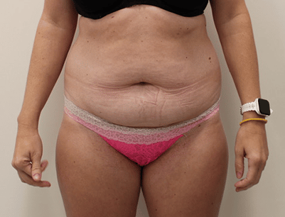 Tummy Tuck before and after - before