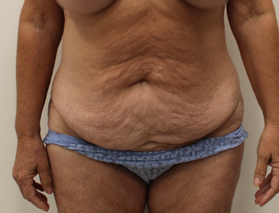 Tummy Tuck before and after - before