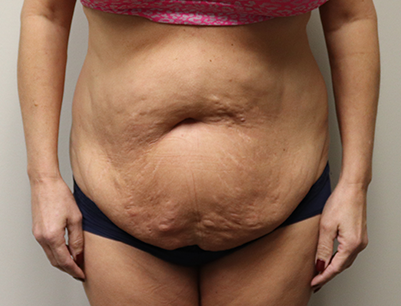 Tummy Tuck before and after - before