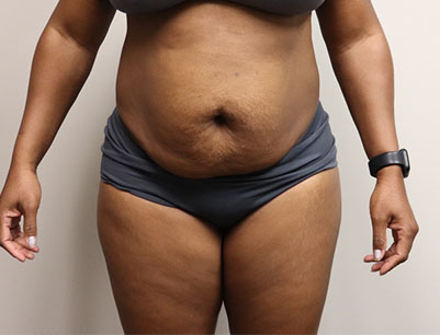 Tummy Tuck before and after - before