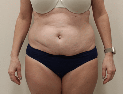 Tummy Tuck before and after - before