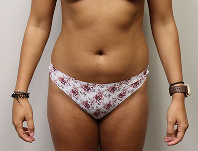 Liposuction before and after - before