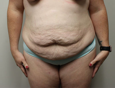 Tummy Tuck before and after - before