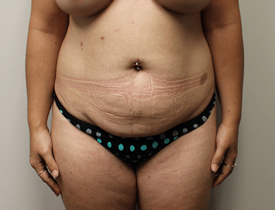 Tummy Tuck before and after - before