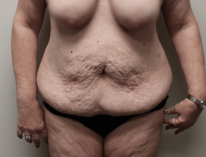 Tummy Tuck before and after - before