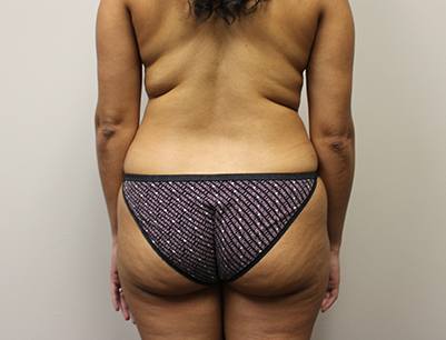 Liposuction before and after - before