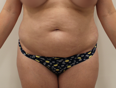 Tummy Tuck before and after - before